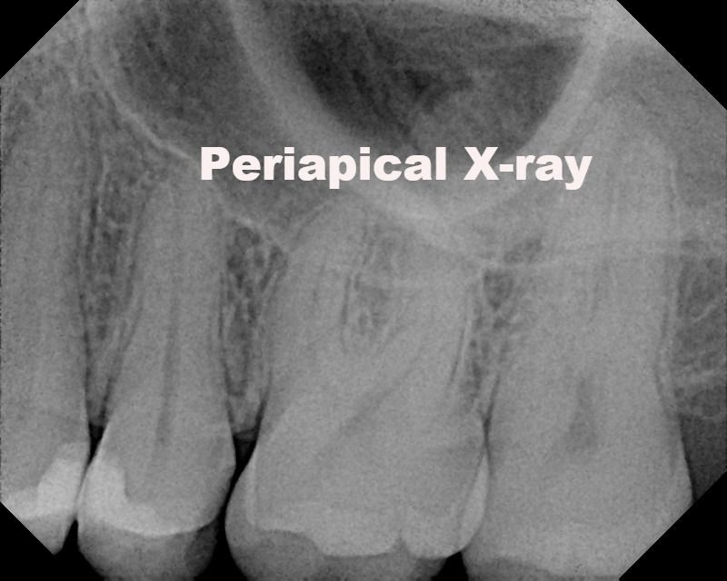 Periapical X-ray at Alpha Dental Care St. Louis